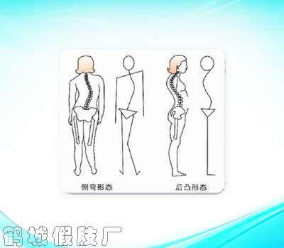 脊柱侧弯矫形器