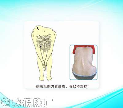脊柱侧弯矫形器3