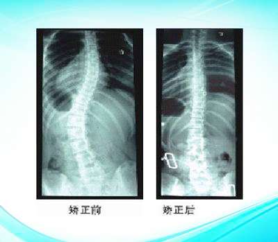 脊柱侧弯矫形器2